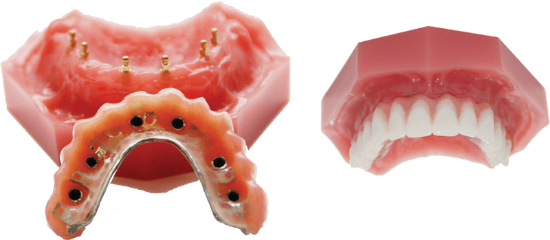 Dentures in Scottsdale, AZ - Implant Supported Dentures