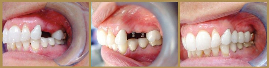 Mini-Dental-Implants---Before-and-After
