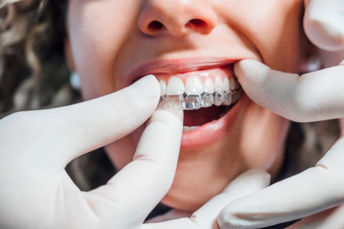 Orthodontics in Scottsdale, AZ - Orthodontist - Krystal Klear Aligners - Invisalign Alternative