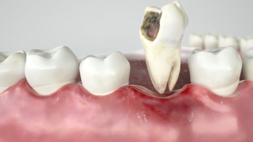 Tooth Extractions in Scottsdale, AZ
